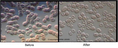 Stacked red blood cells before and after Nattokinase