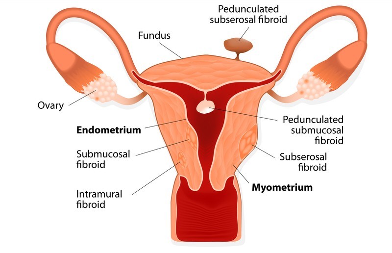 Fibroids - Shrink Fibroids Naturally